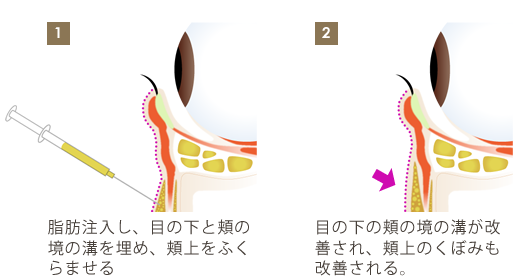 脂肪の膨らみがなく、凹んでしまっている方向け